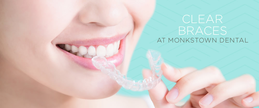 clear braces at Monkstown