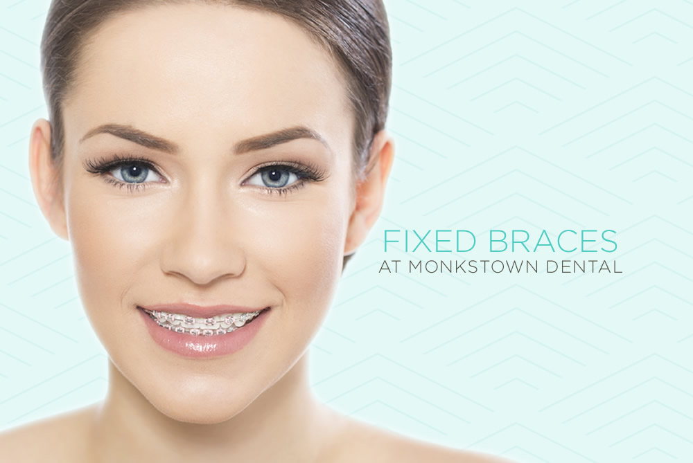 fixed braces at Monkstown