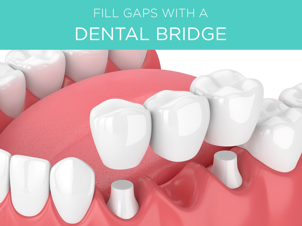 dental bridge