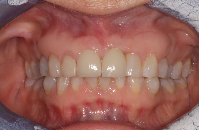 gum graft treatment in belfast