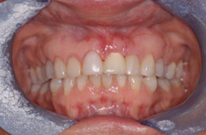 Monkstown dental gum graft before and after belfast