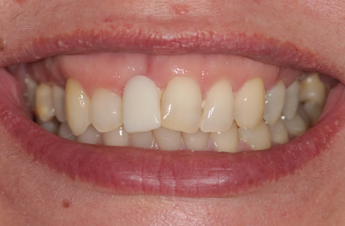 Monkstown Orthodontica before and after belfast