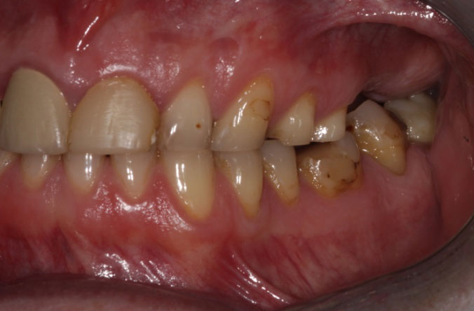 Monkstown dental tooth wear before and after belfast